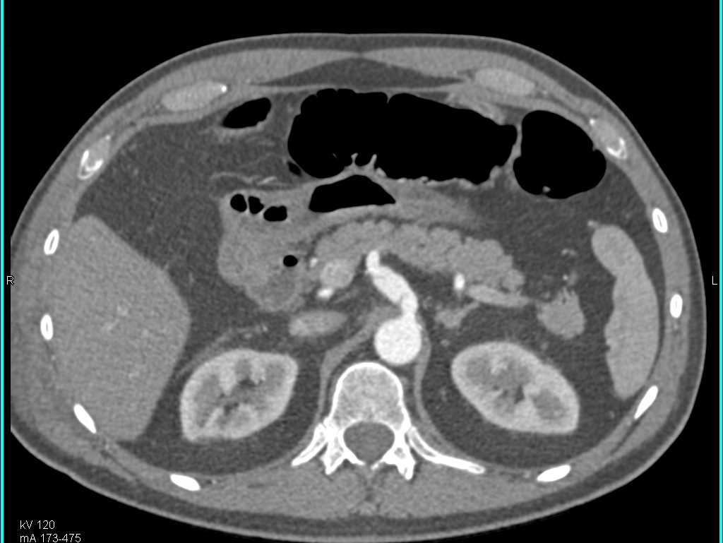 Celiac Artery Dissection - CTisus CT Scan