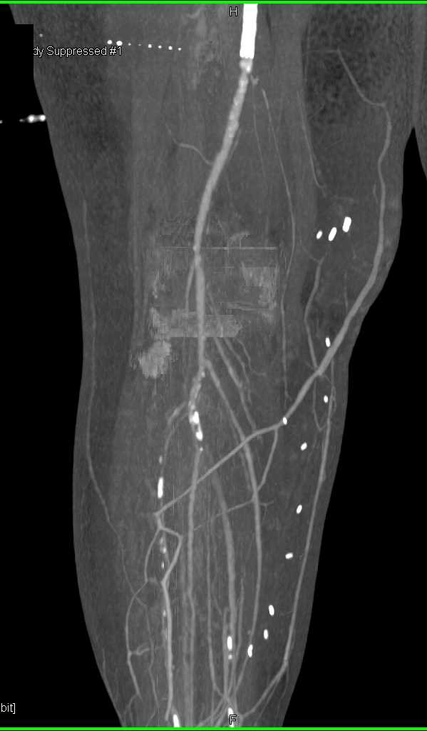 Peripheral Vascular Disease (PVD) Calf - CTisus CT Scan