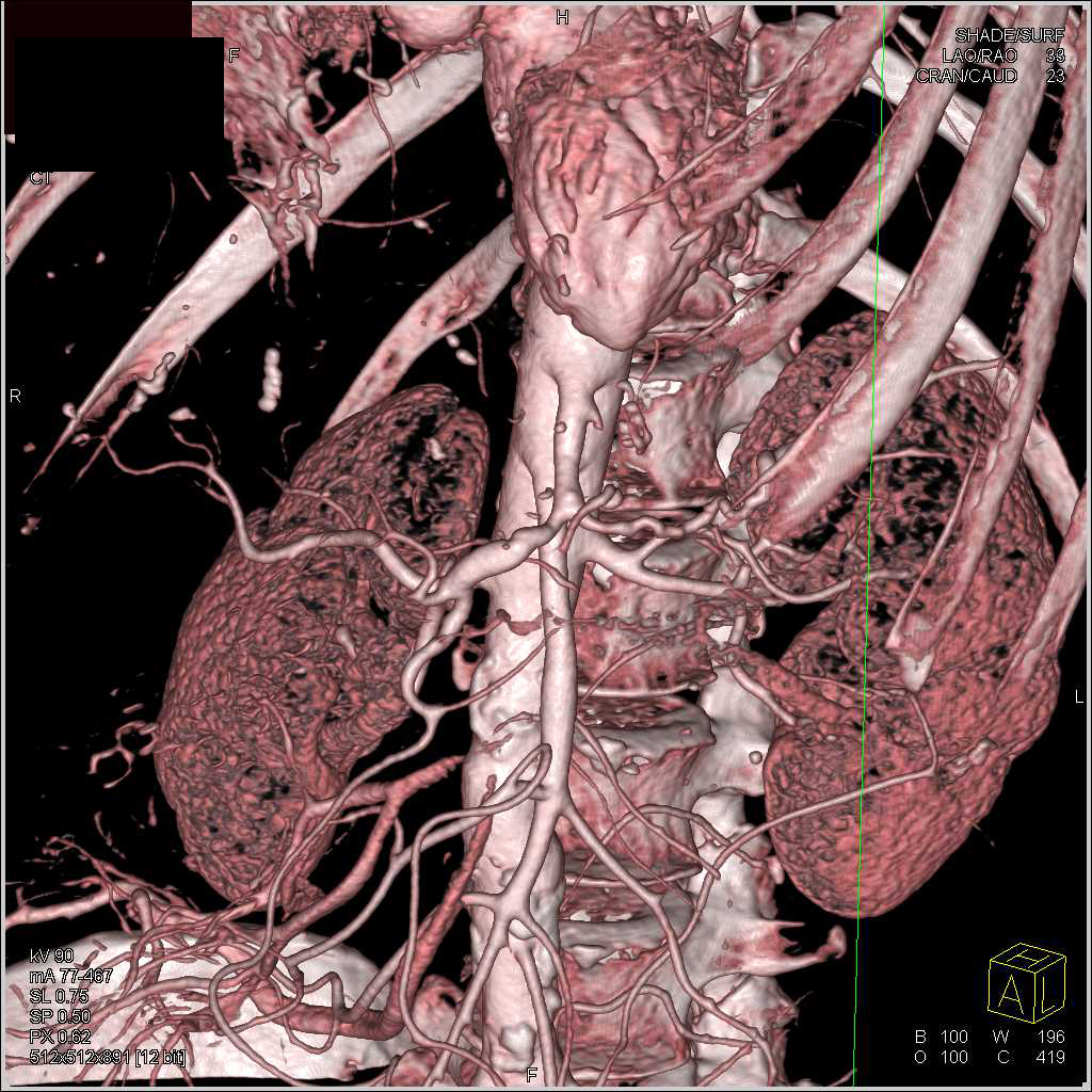 Stenosis Hepatic Artery - CTisus CT Scan