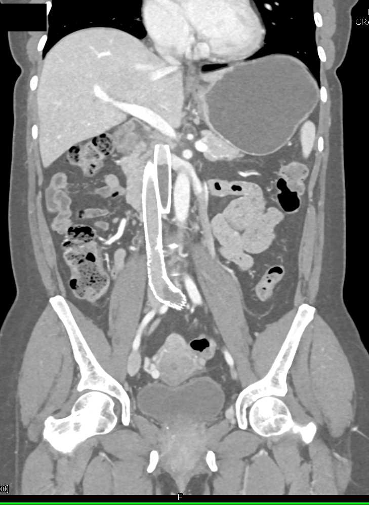 Inferior Vena Cava (IVC) Stents with Thrombus - CTisus CT Scan