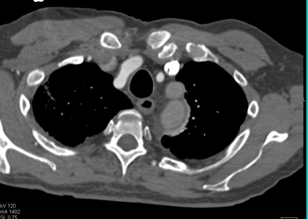 Type B Dissection - CTisus CT Scan