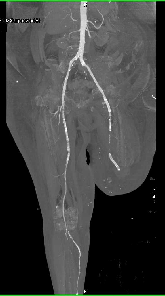 Peripheral Vascular Disease (PVD) with Left Sided Amputation - CTisus CT Scan