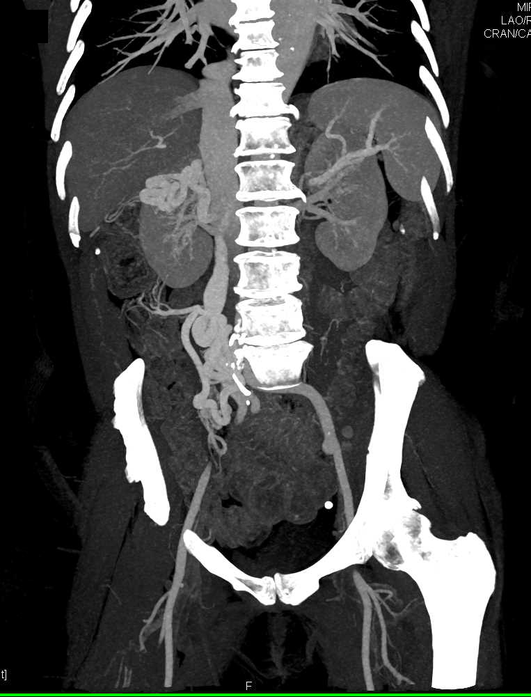 Inferior Vena Cava (IVC) Occlusion with Collaterals - CTisus CT Scan