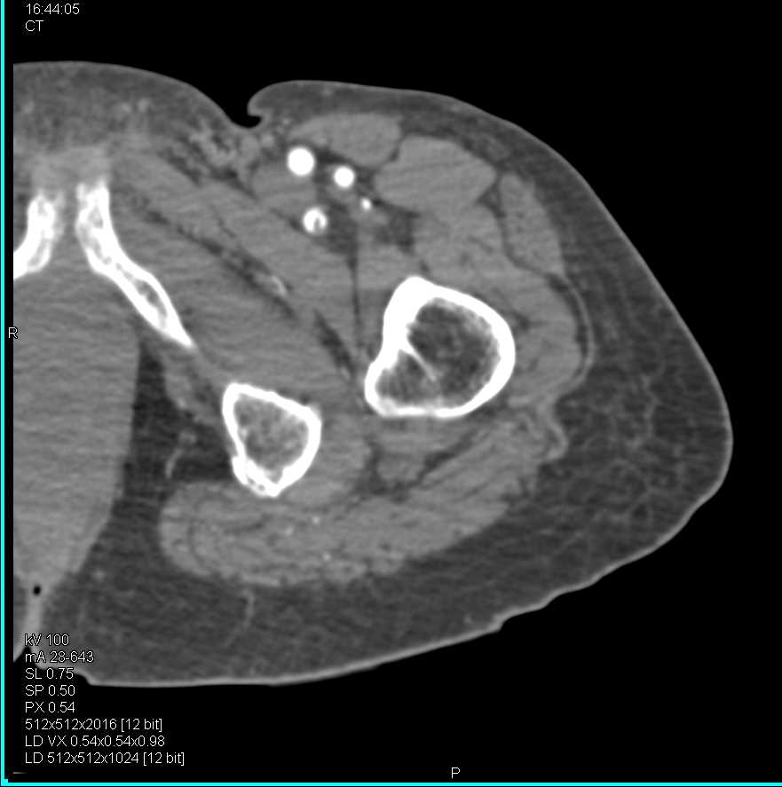 Occluded Left Popliteal Artery - CTisus CT Scan