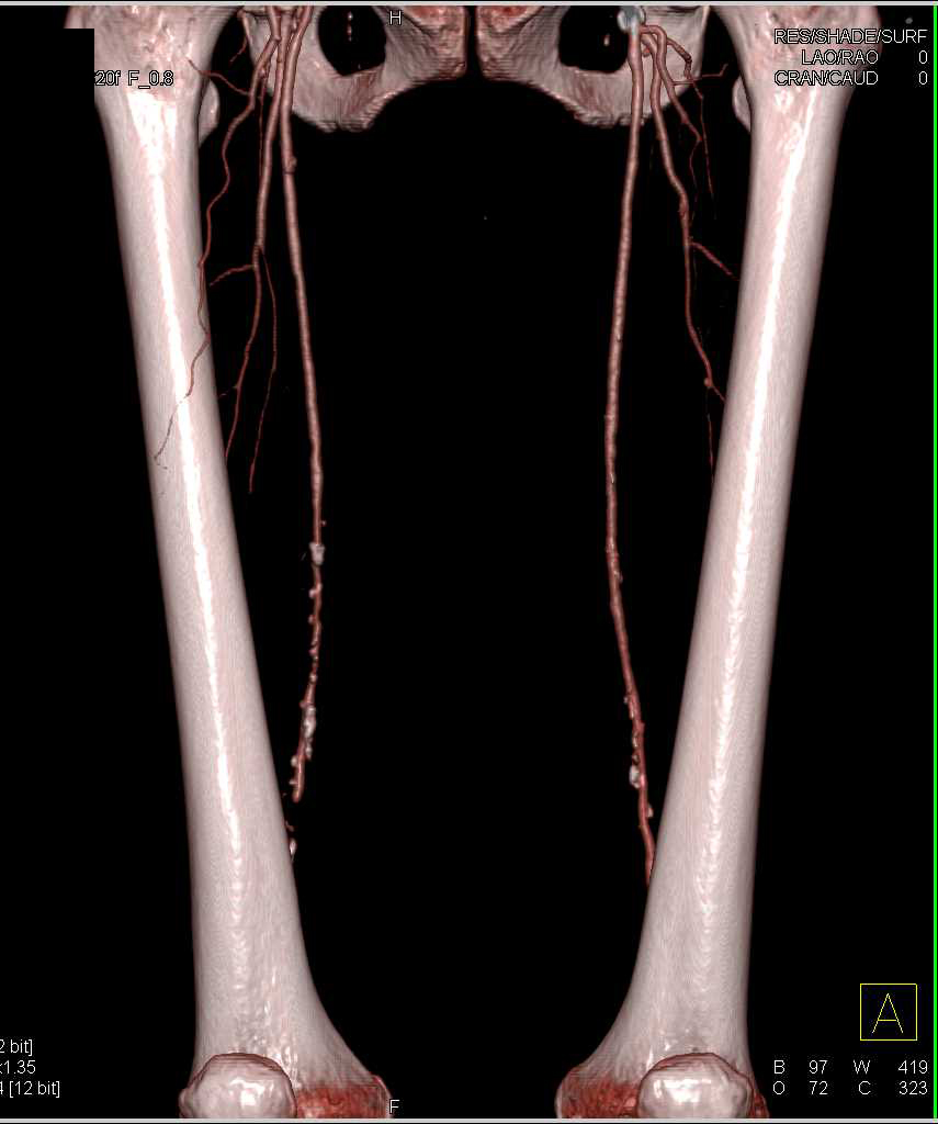 Extensive Plaque in the Superficial Femoral Artery (SFA) - CTisus CT Scan