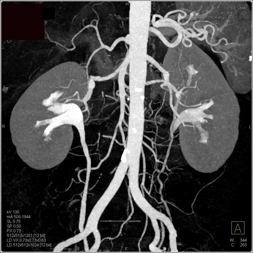CTA and CT Urogram Together - CTisus CT Scan