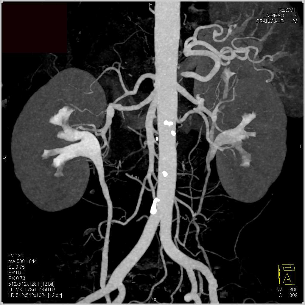 CTA and CT Urogram Together - CTisus CT Scan