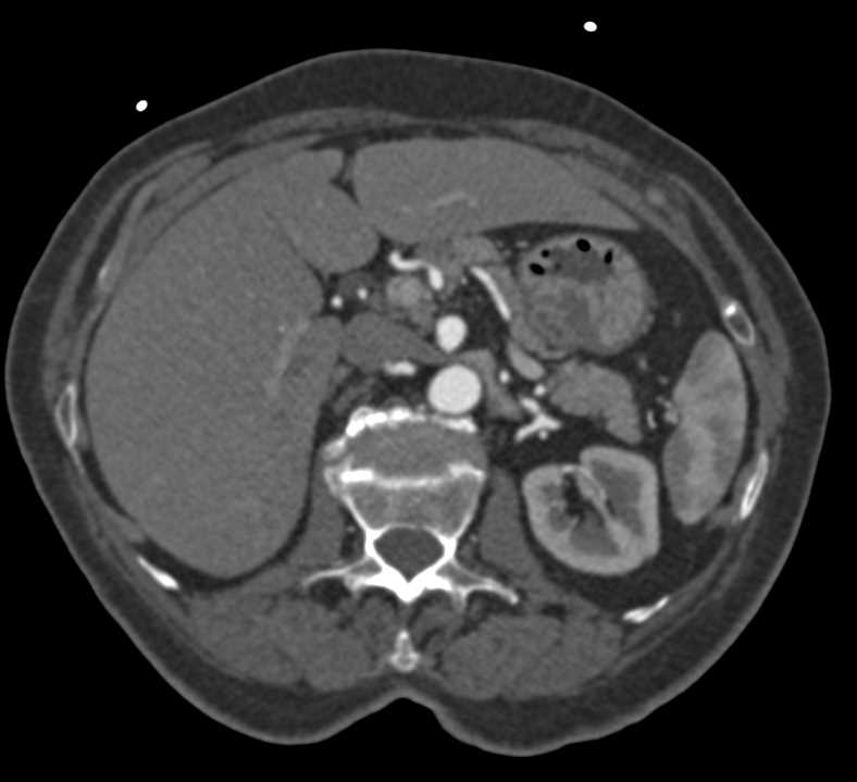 fmd-fibromuscular-dysplasia-involves-the-renal-arteries-and-the