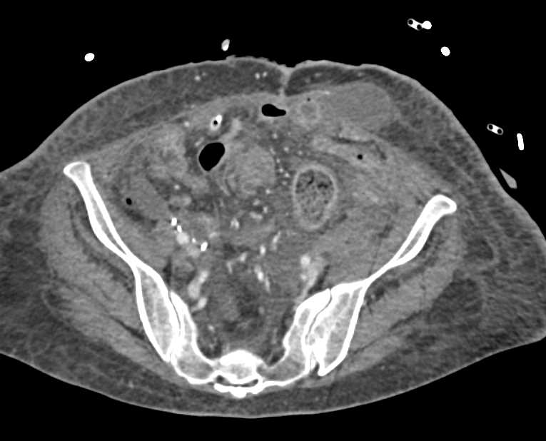 Occlusion Left Common Iliac Artery - CTisus CT Scan