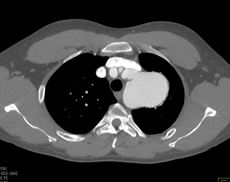 Large Aneurysm off the Arch - CTisus CT Scan