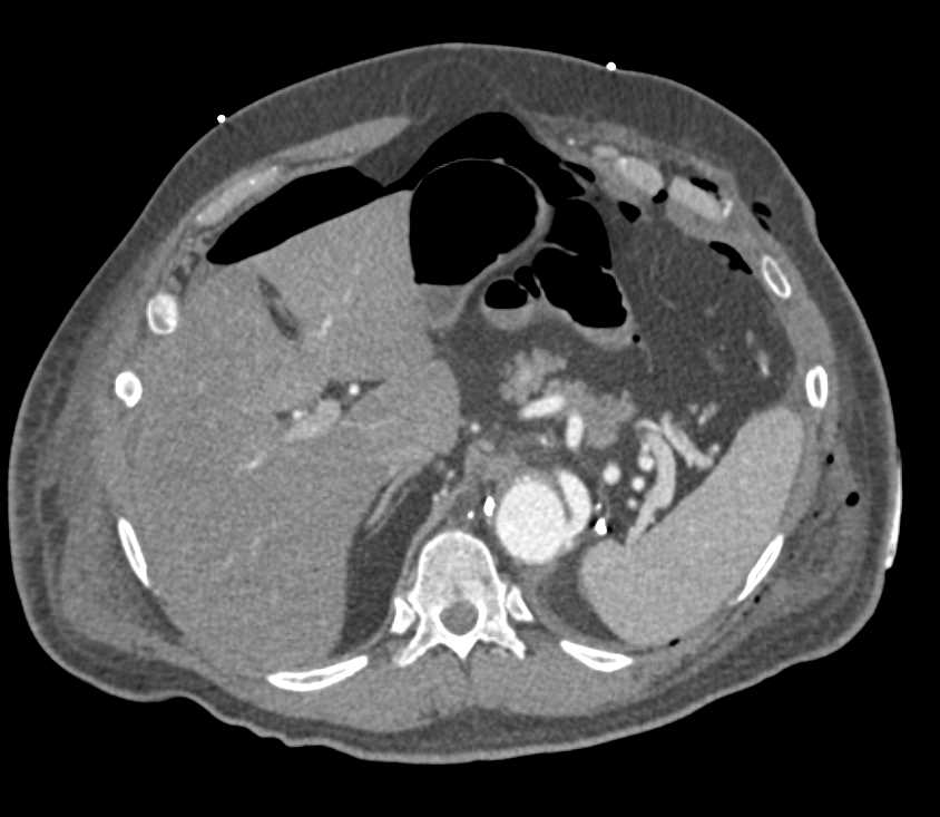 Pneumoperitoneum Post Vascular Surgery - CTisus CT Scan