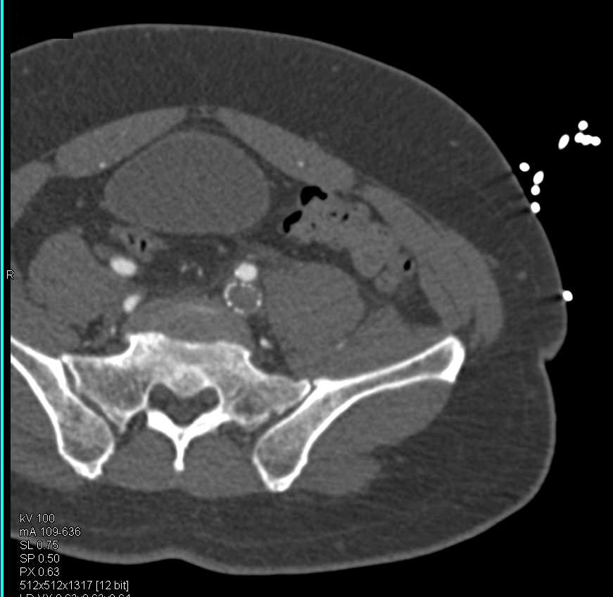 Occluded Stent in the Left Iliac Vein - CTisus CT Scan