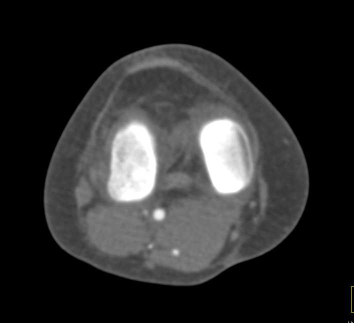 Occlusion Distal Anterior Tibial Artery on CTA - CTisus CT Scan