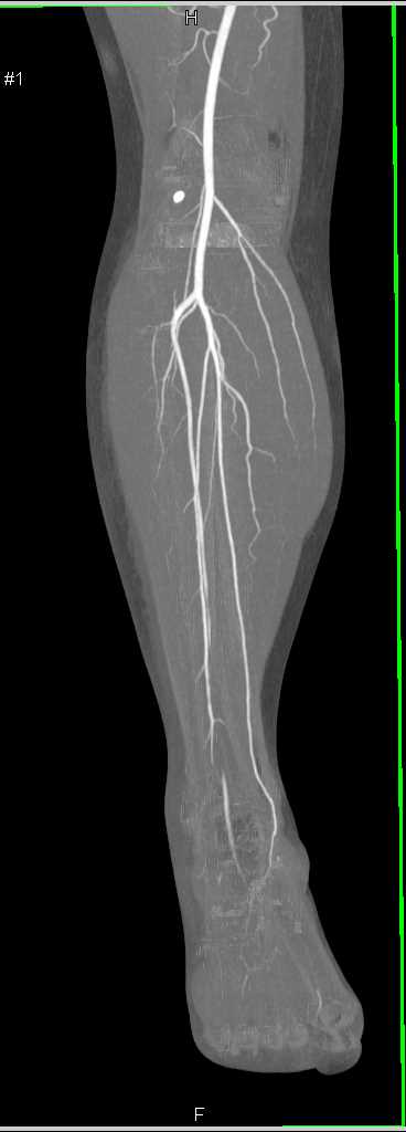 Ultrasound Image Of Distal Anterior Tibial Artery Realtec | My XXX Hot Girl