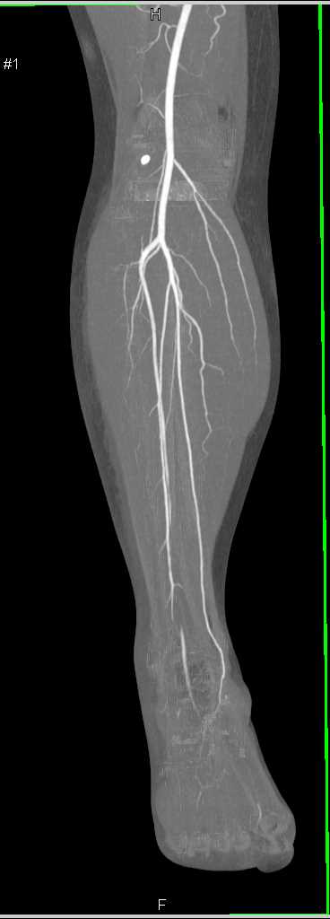 Ultrasound Image Of Distal Anterior Tibial Artery Realtec My XXX Hot Girl