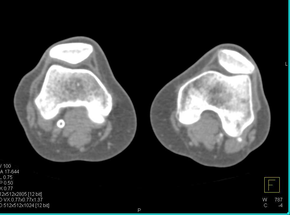 Occluded Right Popliteal Artery with Stent - CTisus CT Scan