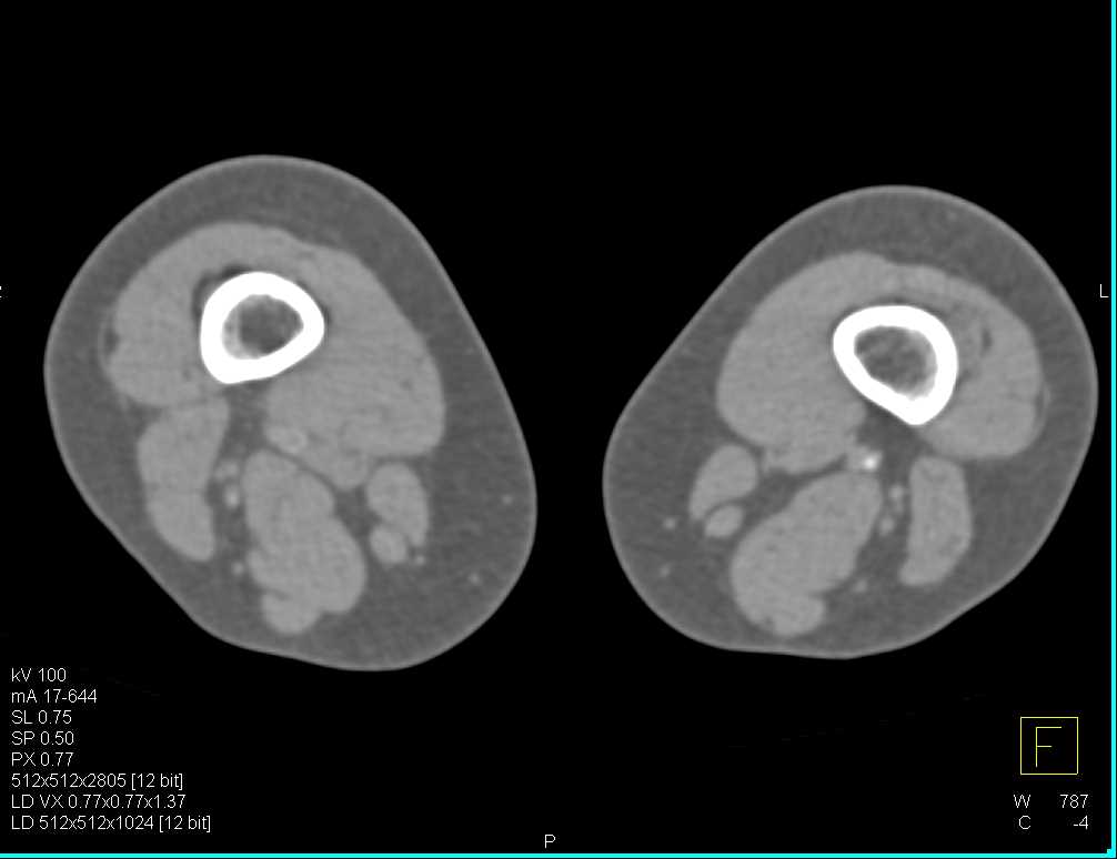 Occluded Right Popliteal Artery with Stent - CTisus CT Scan