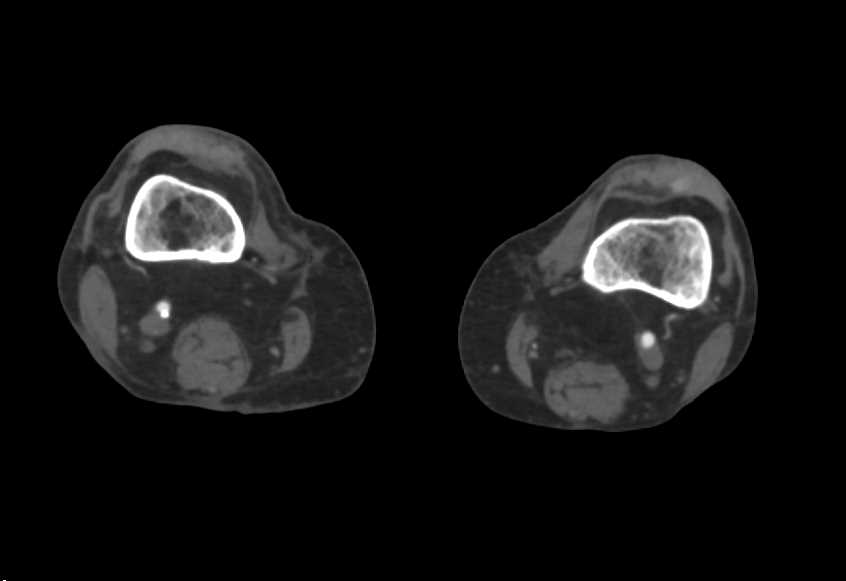 Peripheral Vascular Disease - CTisus CT Scan