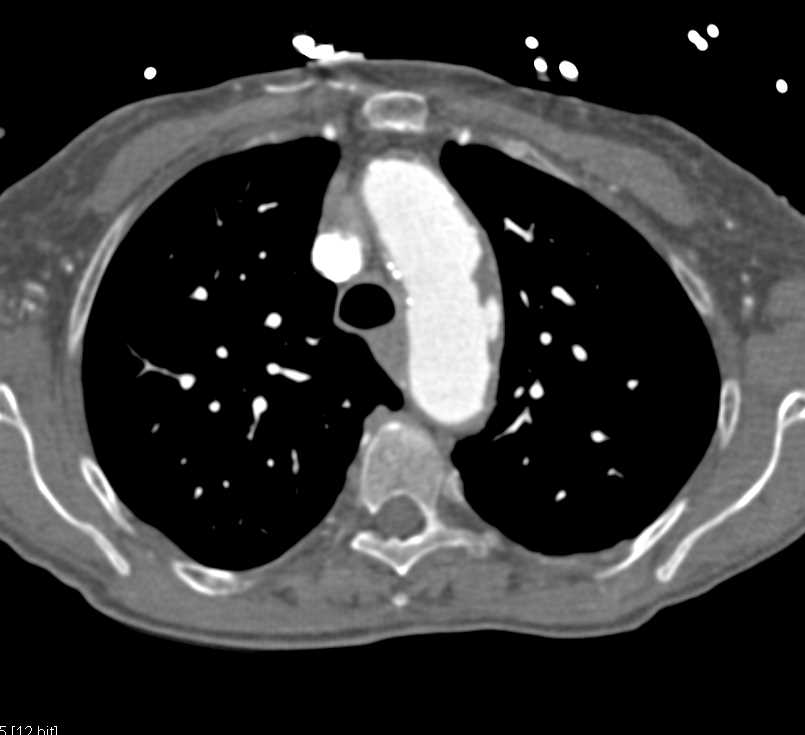 Multiple Aortic Aneurysms - CTisus CT Scan