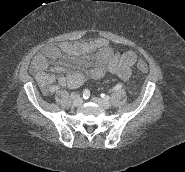 Superior Mesenteric Artery (SMA) and Superior Mesenteric Vein (SMV) Clot with Edematous Small Bowel - CTisus CT Scan