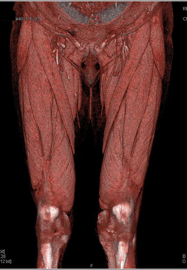 Peripheral Vascular Disease - CTisus CT Scan