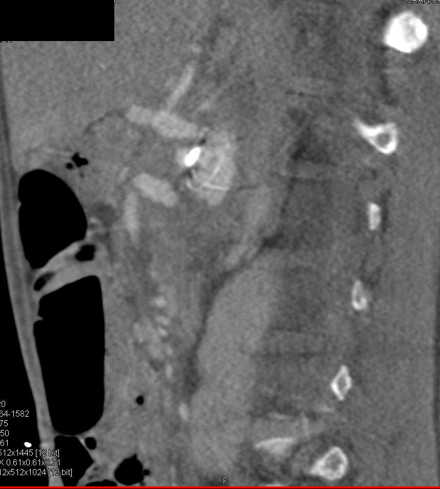 Aortic Aneurysm with Stent and Right Renal Infarcts - CTisus CT Scan