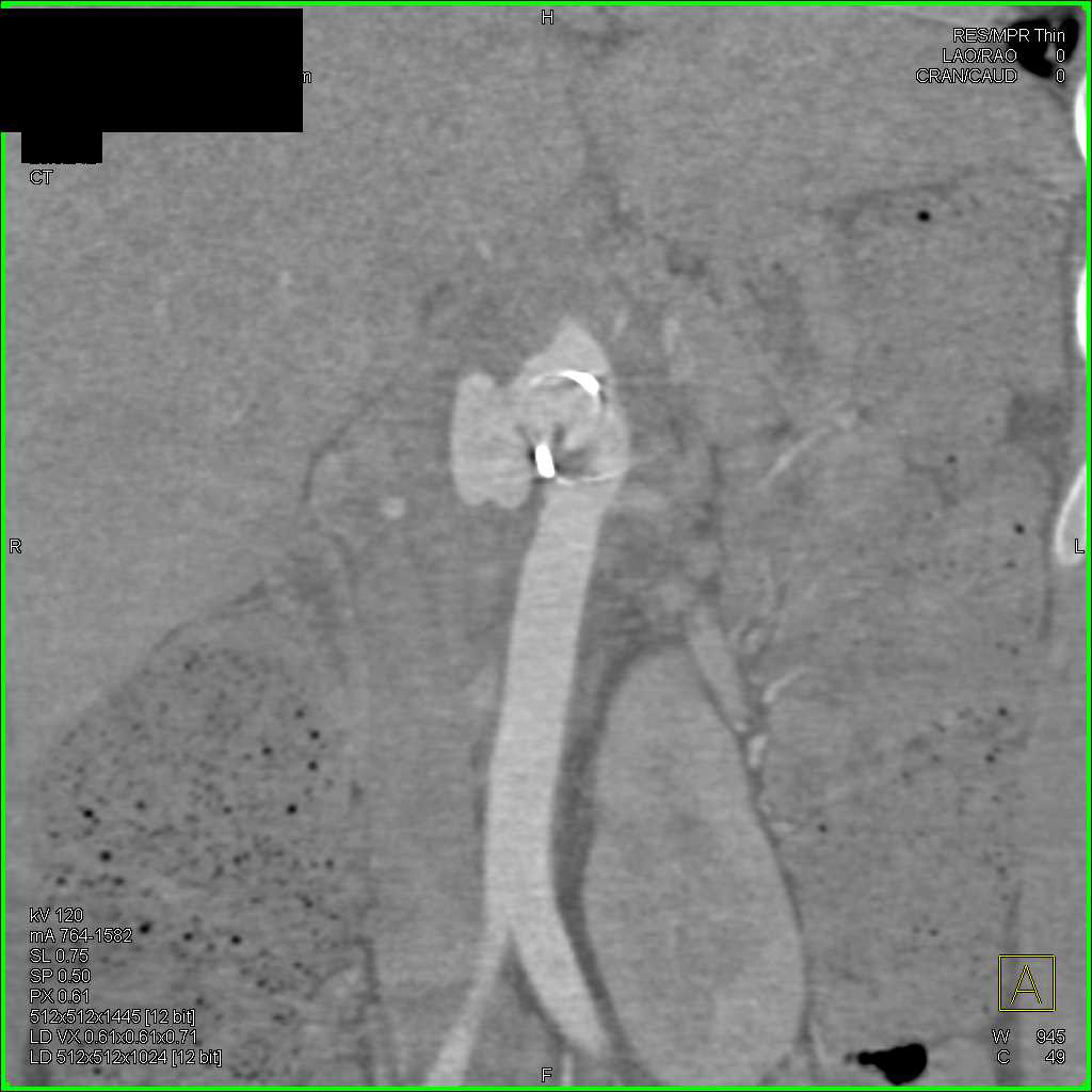Aortic Aneurysm with Stent and Right Renal Infarcts - CTisus CT Scan