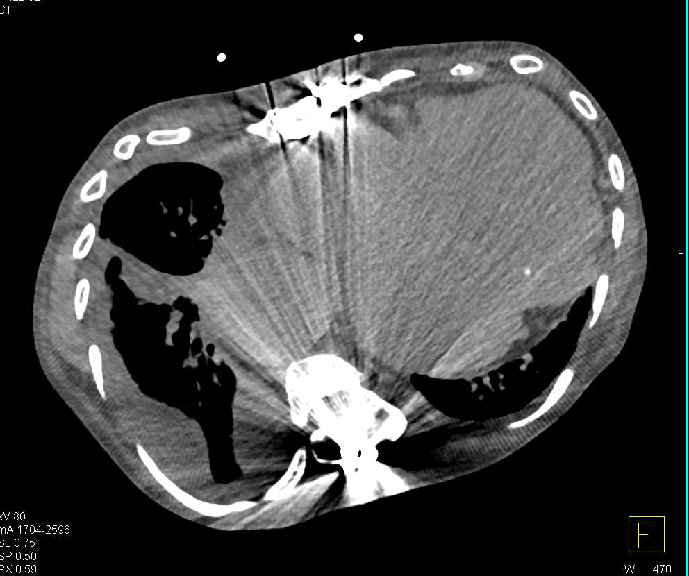 Complex  Aortic Dissection - CTisus CT Scan