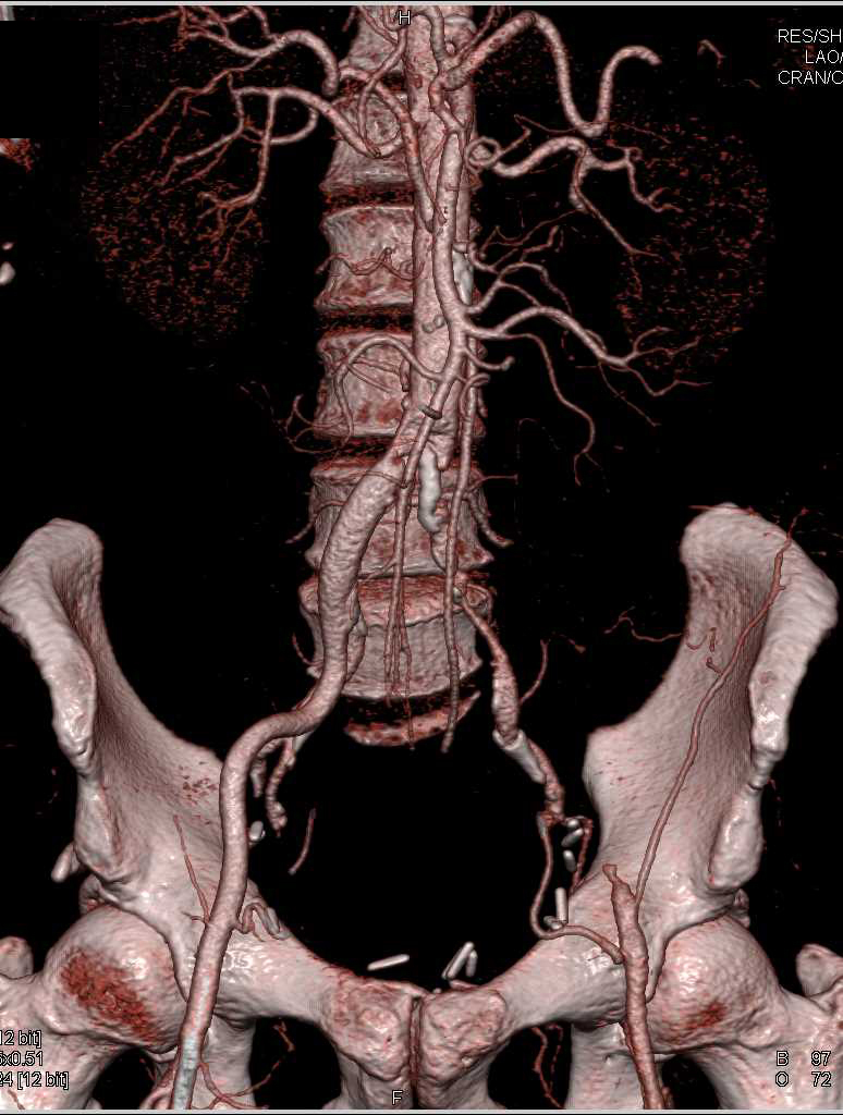 Near Occlusion of the Left Common Iliac Artery - CTisus CT Scan