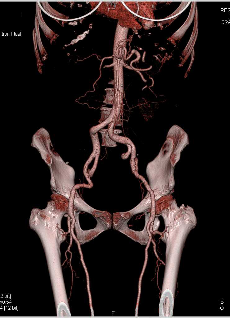 Pre-Op Planning for Vascular Access for Transcatheter Aortic Valve Replacement (TAVR) - CTisus CT Scan