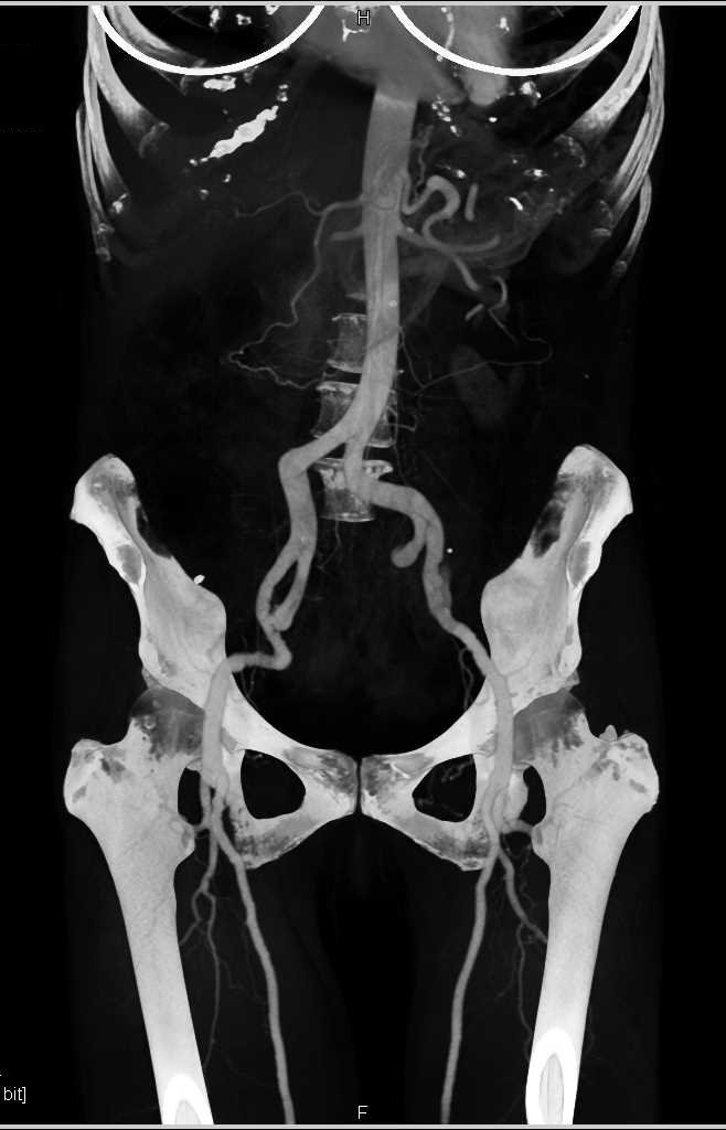 Beading in the External Iliac Arteries - CTisus CT Scan