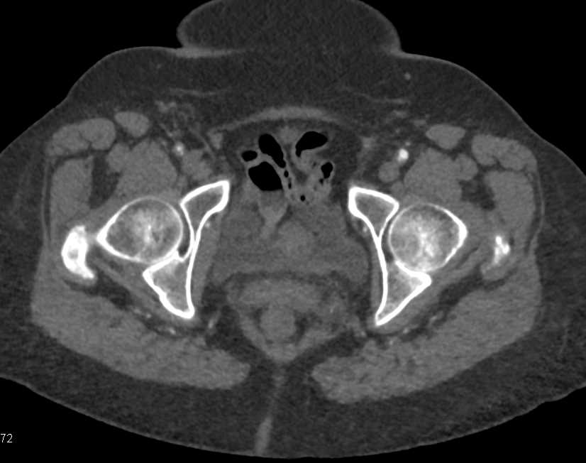 Extensive Peripheral Arterial Disease (PAD) with Occlusion of the Superficial Femoral Arteries (SFAs) Bilaterally - CTisus CT Scan