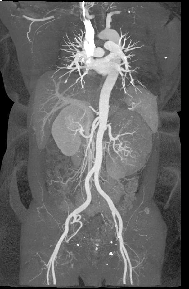 CTA Aorta and Branches with VRT and Cinematic Rendering - CTisus CT Scan