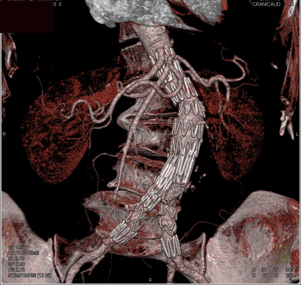 Endovascular Stent - CTisus CT Scan