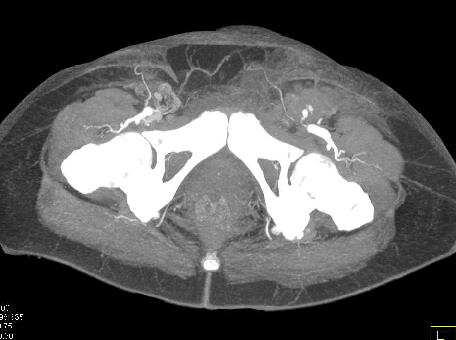 Induration Left Groin from Prior Catheterization - CTisus CT Scan