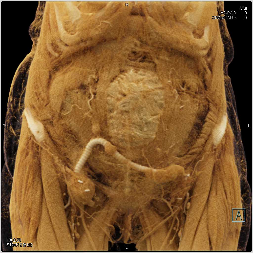 Fem-Fem Bypass Graft with Cinematic Rendering - CTisus CT Scan