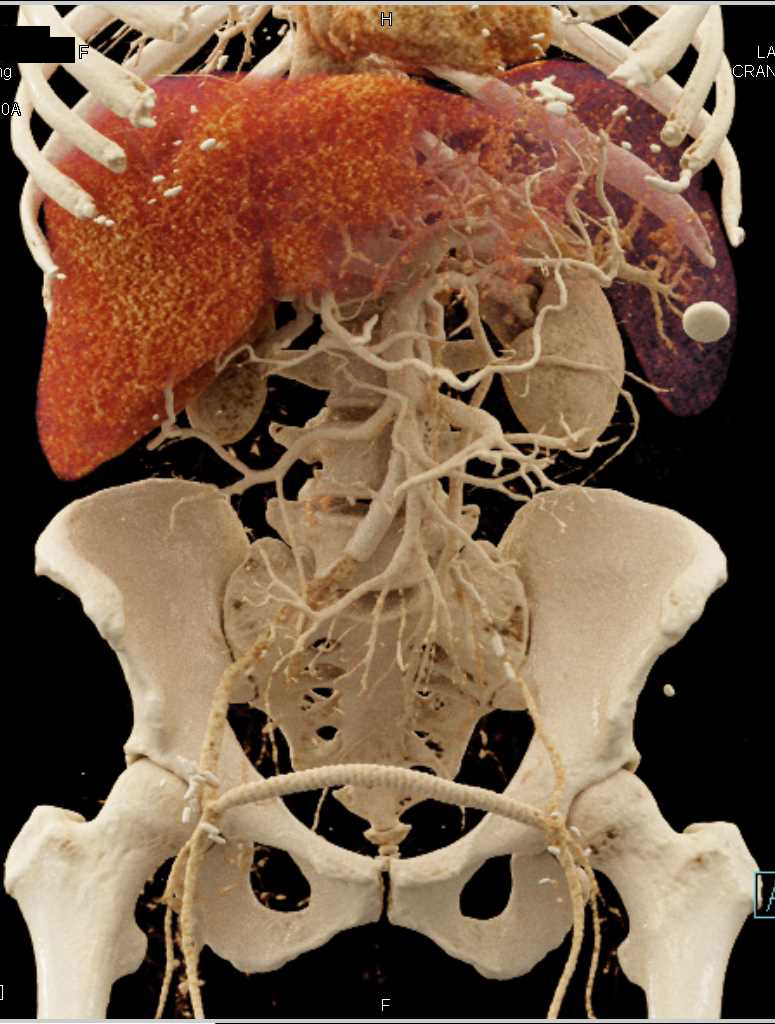 Vascular Disease with Fem-Fem Bypass - CTisus CT Scan