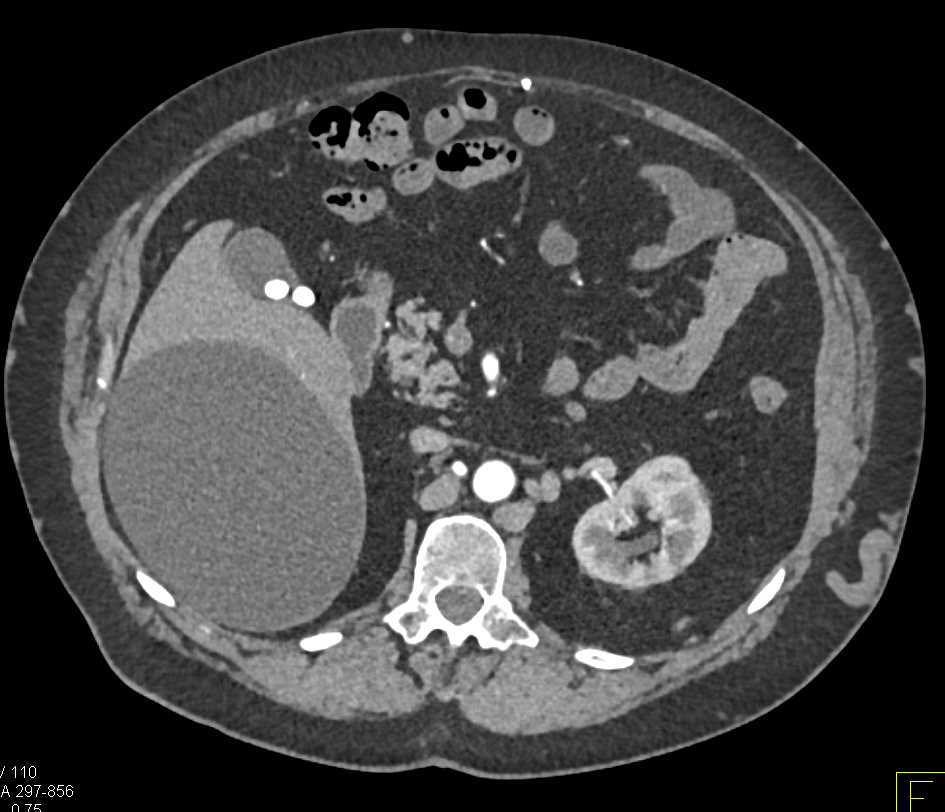 Collateral Vessels in the Abdominal Wall - CTisus CT Scan