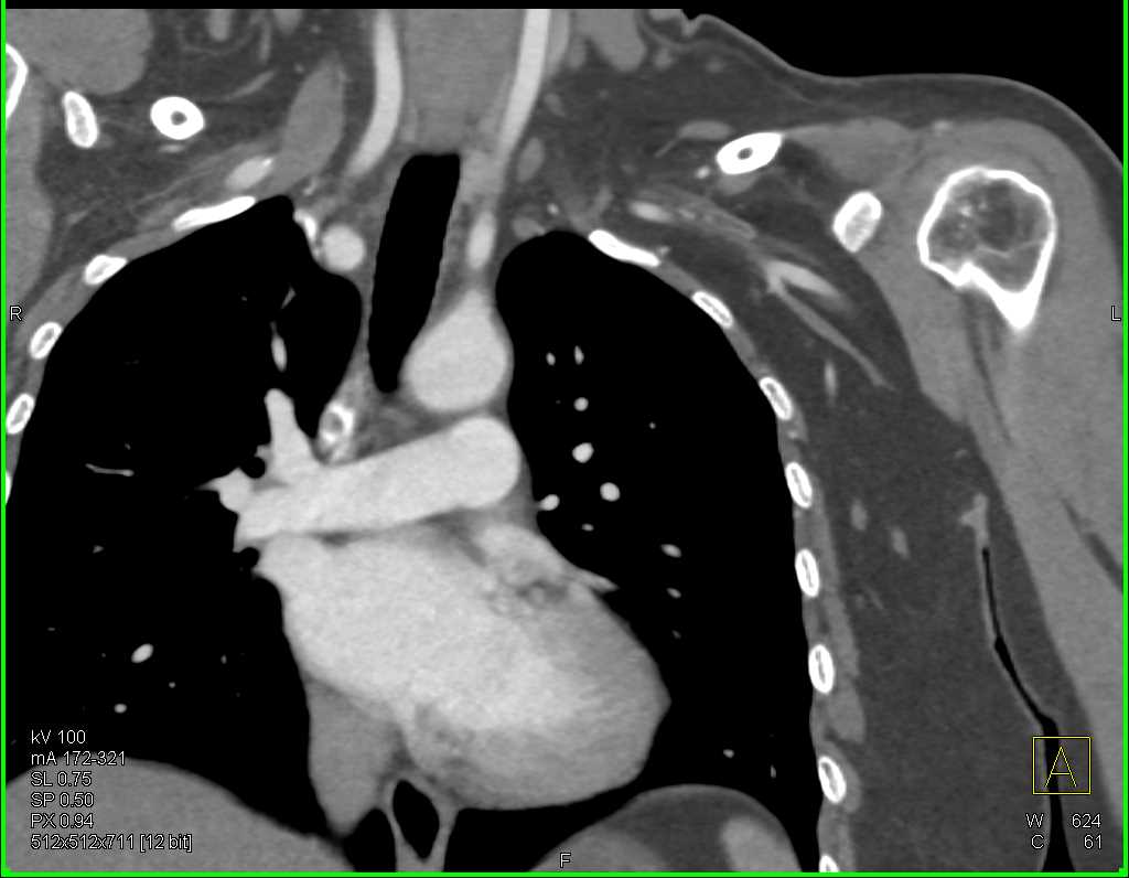 Clot in the Left Subclavian Artery - CTisus CT Scan