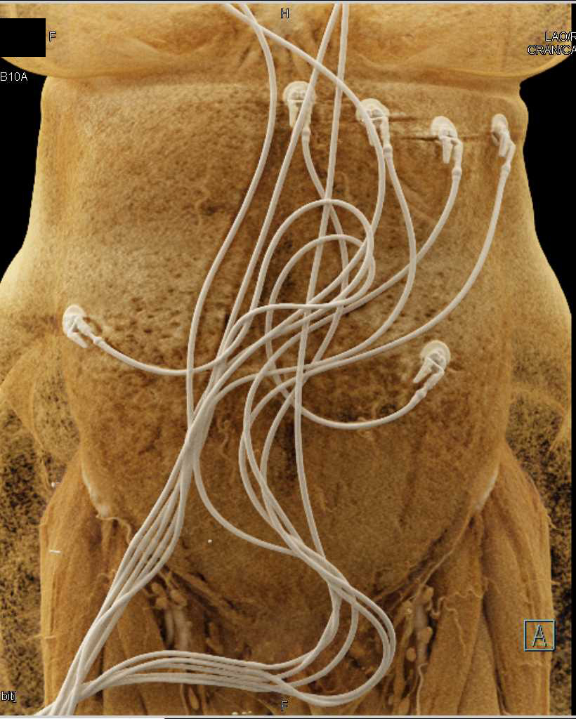 CTA of the Mesenteric Vasculature with Cinematic Rendering - CTisus CT Scan