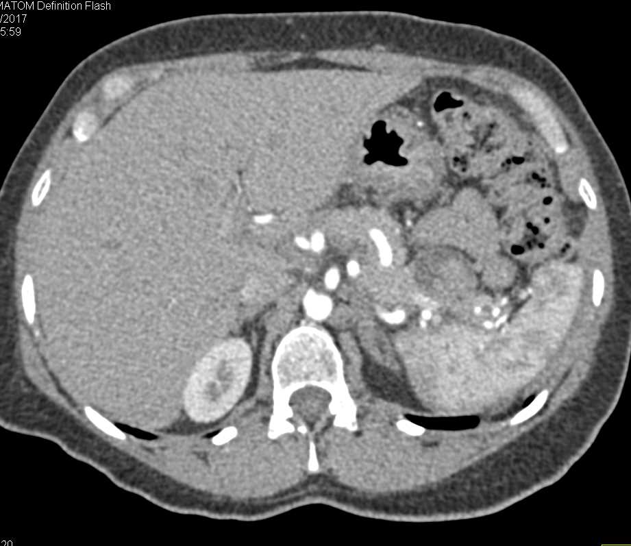 Mesenteric Vasculature - CTisus CT Scan