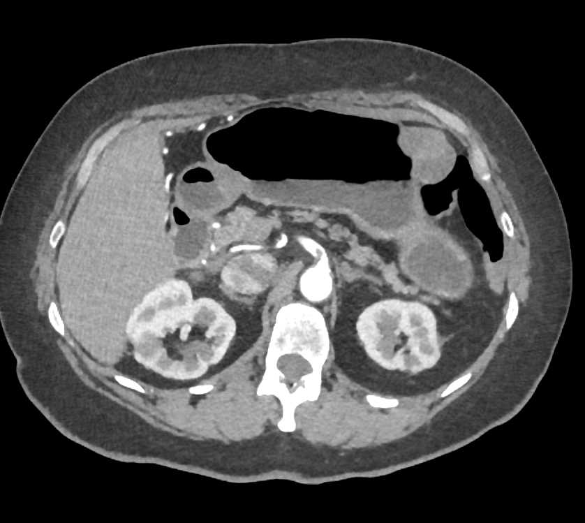 Stenosis Celiac and Superior Mesenteric Artery (SMA) - CTisus CT Scan