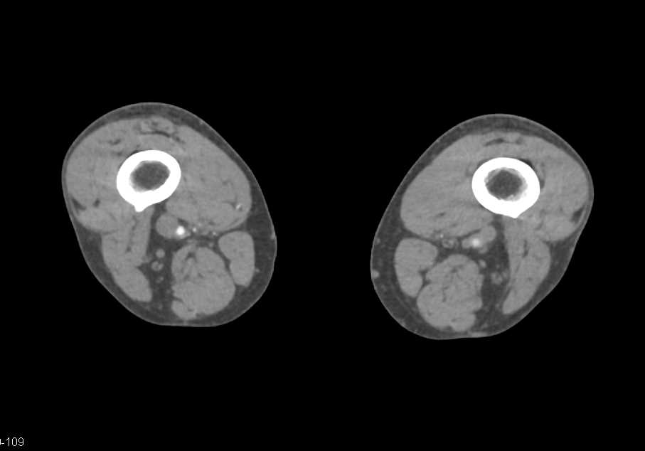 CTA Runoff with Peripheral Arterial Disease (PAD) - CTisus CT Scan