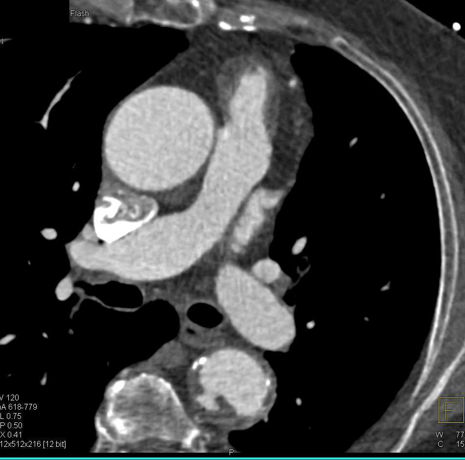 Ulcerating Plaque Descending Aorta - CTisus CT Scan