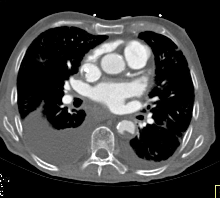 Plaque in the Aorta and Peripheral Arterial Disease (PAD) - CTisus CT Scan