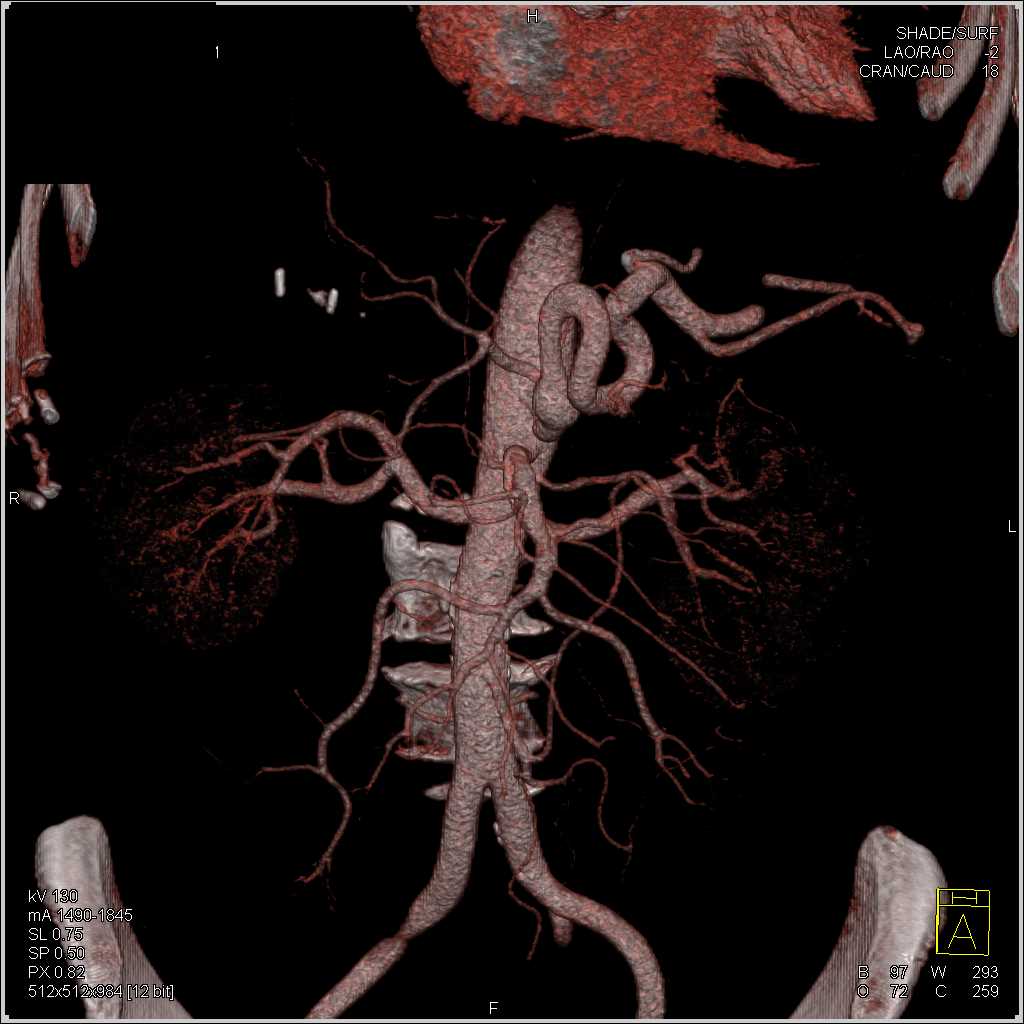 Celiac Artery Aneurysm - CTisus CT Scan