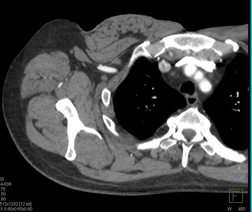 Vascular Mapping for Reconstructive Surgery - CTisus CT Scan