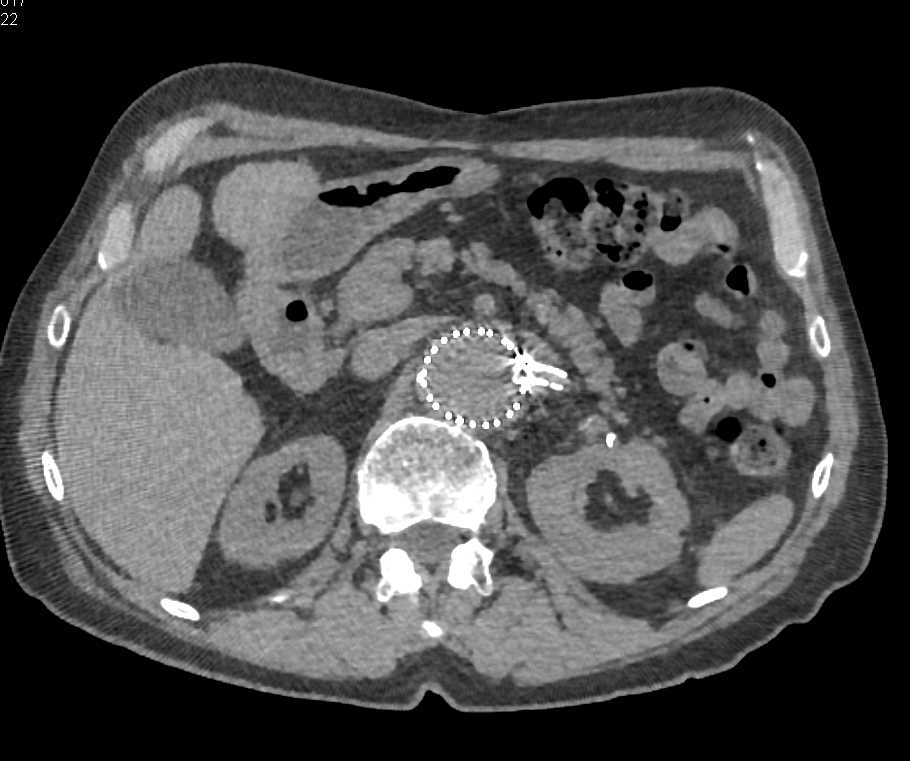 Stents in the Renal Arteries - CTisus CT Scan