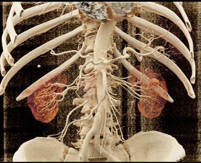 Vascular Malformation Left Kidney with Cinematic Rendering - CTisus CT Scan