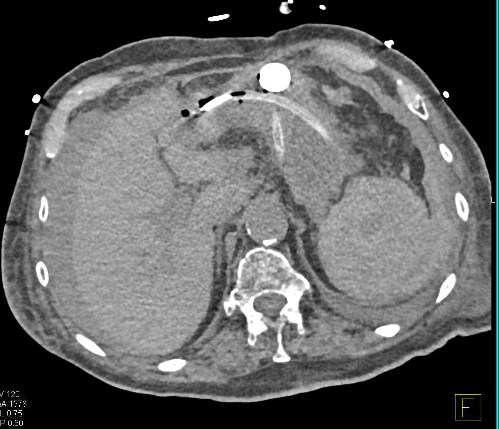 Type B Leak and Abdominal Bleed - CTisus CT Scan